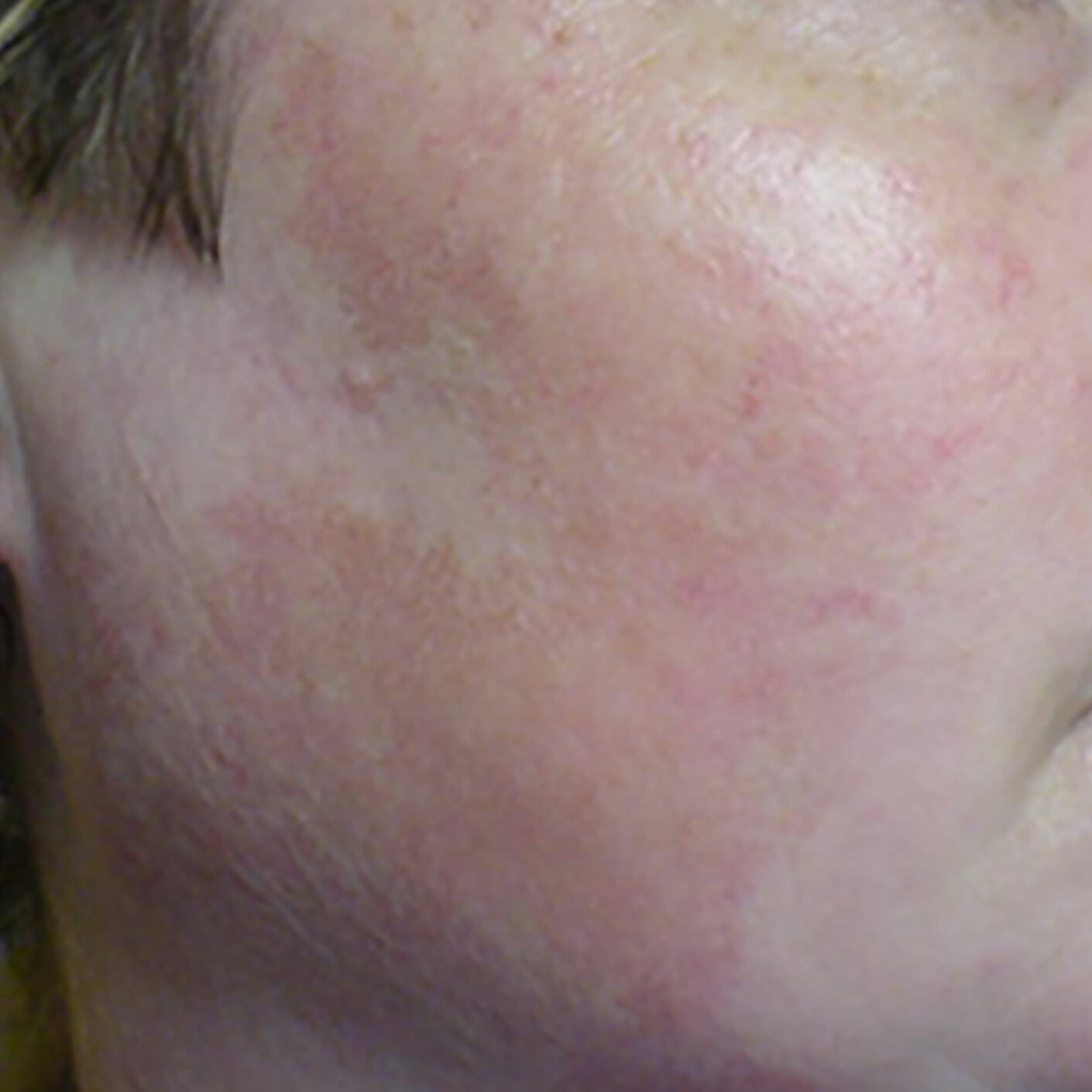 Couperose Treatment of red veins Perfect Skin Rostock